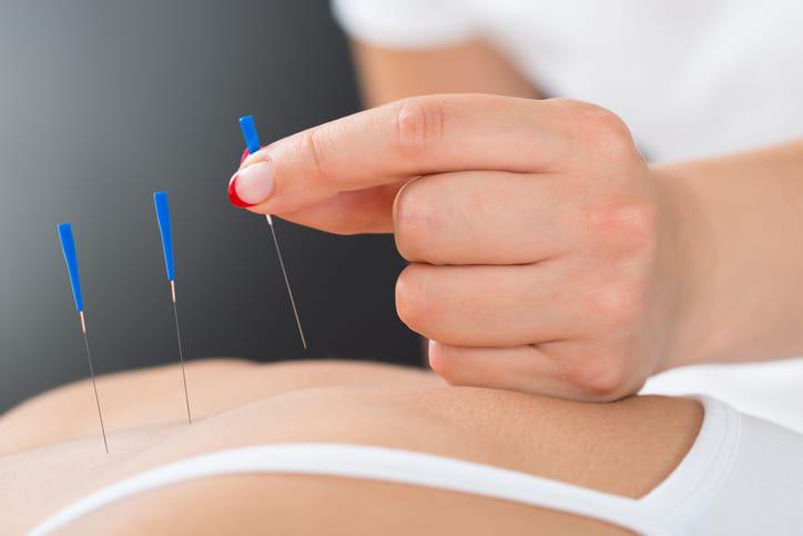 Berbagai Manfaat dan Risiko Melakukan Akupuntur